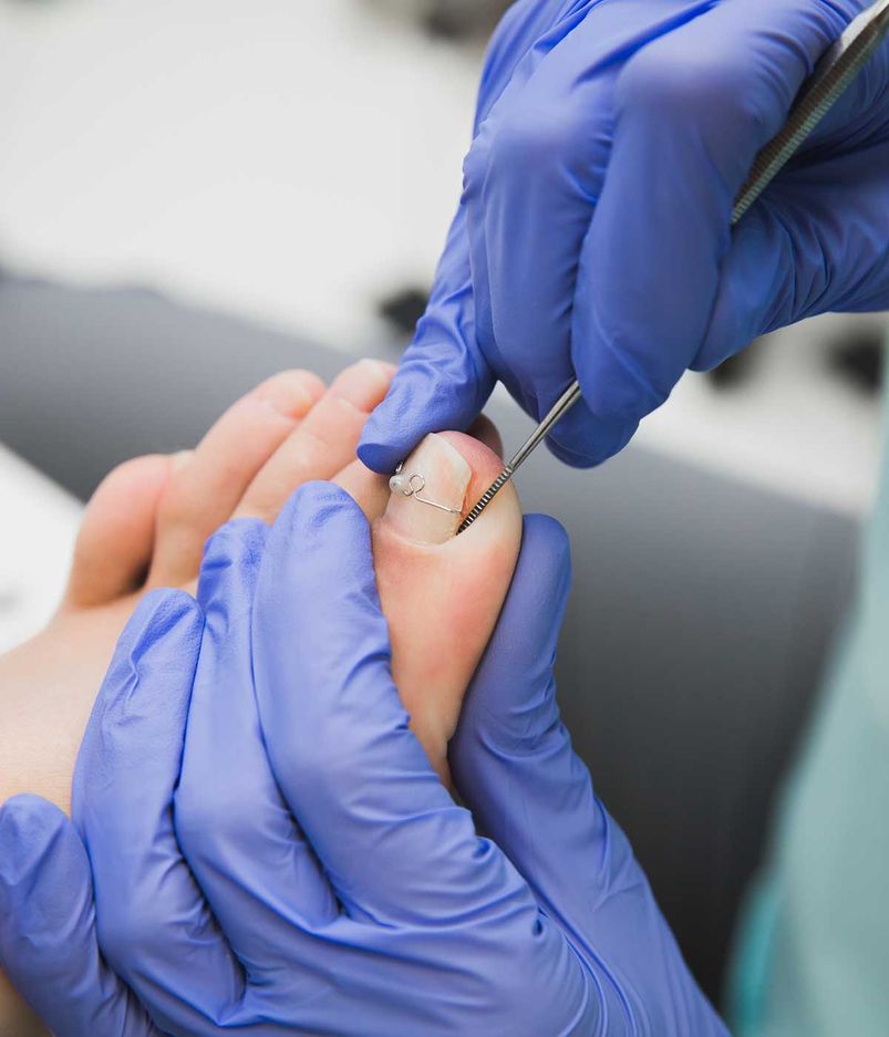 Nagelclip. Ein Podologe behandelt einen eingewachsenen Zehennagel. Medizinisches Pediküre-Verfahren. Orthonyx-Halterung